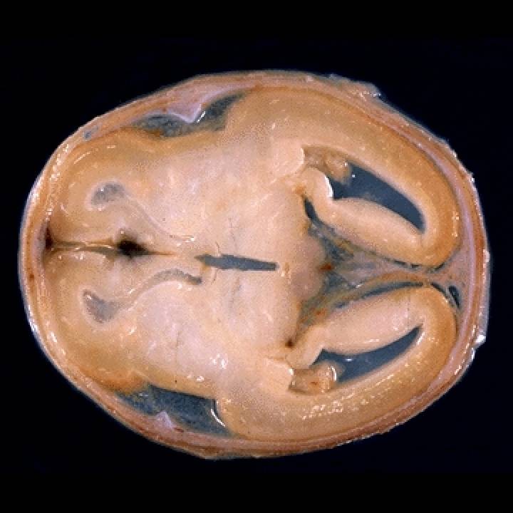 Foetus Brain image