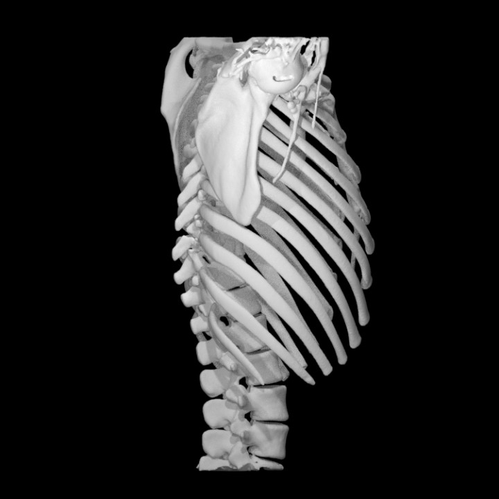Spine with a T10 chance fracture image